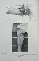 Rare Antique 1931 Book Matas Birthday Volume, A Collection Of Surgical Essays