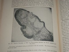 1921 GYNECOLOGICAL & OBSTETRICAL MONOGRAPHS APPLETON VOLUME LOT OF 14 – KD 2998